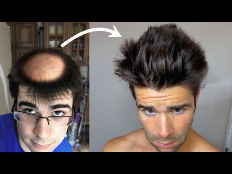 How My Hair Grew Back Double - After losing it?