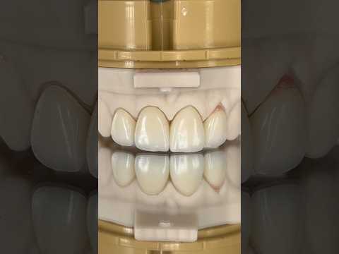 Anterior Zirconia Crowns with Minimal Pink Porcelain #lsk121shorts #dentist #teeth