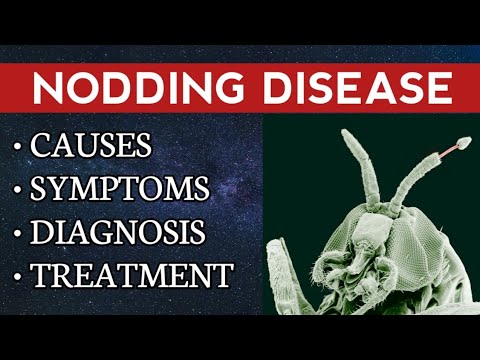 Nodding Syndrome Causes, Symptoms, Diagnosis & Treatment | Onchocerca volvulus