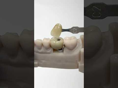 Molar Implant #lsk121shorts #dentist #teeth