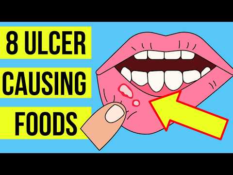 8 FOODS and DRINKS causing MOUTH ULCERS (Canker sore) | Plus treatment