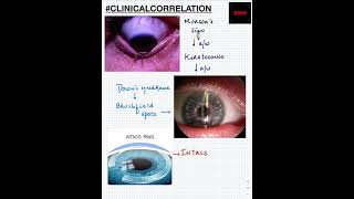 #Shorts|ClinicalCorrelation| NEET/NEXTPG/FMGE/MBBS| Keratoconus | Down's Syndrome | INTACS