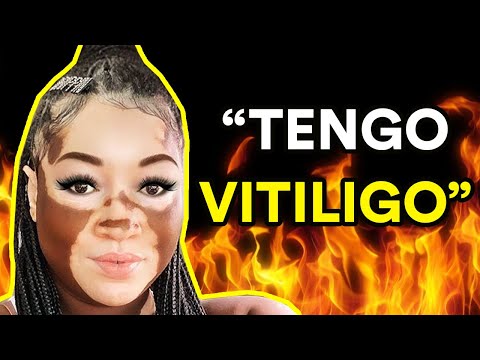 VIVIR CON VITILIGO (Entrevista a Iomikoe Johnson)