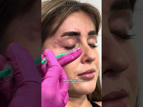 Full Face Botulinum Toxin Injection by Expert Doctor:  Prepare to Be Amazed!