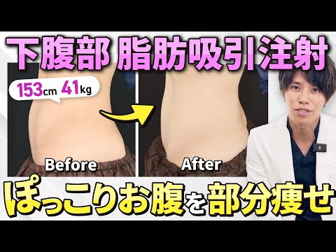 【下っ腹の脂肪吸引】痩せ型だけど下腹部だけぽっこりが気になるBMI18のスタッフさん。短いダウンタイムで部分痩せができる“脂肪吸引注射”【お腹痩せ】