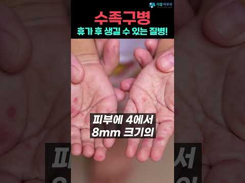 수족구병 무섭습니다! 증상과 원인을 제대로 알아야 하는 피부질환!