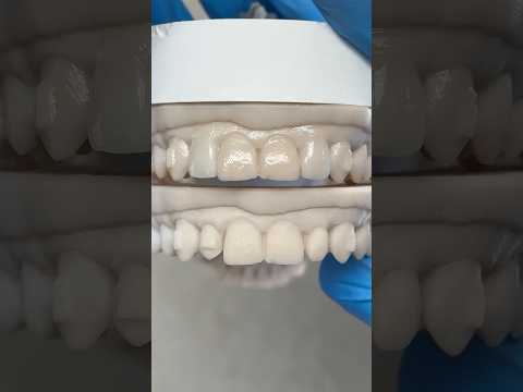 Before and After Veneer Wax-Up #lsk121shorts #dentist #teeth