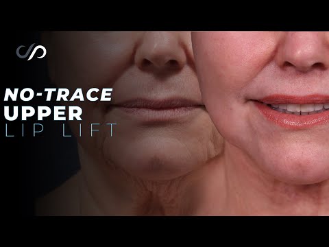 Discover the SECRET to a BEAUTIFUL Upper Lip Lift in 2024