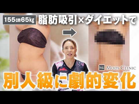 お腹周りの脂肪吸引とダイエットで劇的変化した1年後のリアル！お腹と腰の経過を徹底解説/ボァイエ真希子 医師｜Mods Clinic モッズクリニック（脂肪吸引・注入）