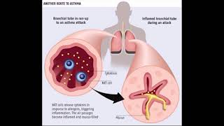 mesothelioma attorney assistance