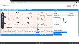 ECG Interpretation Case Walk-Thru | The EKG Guy