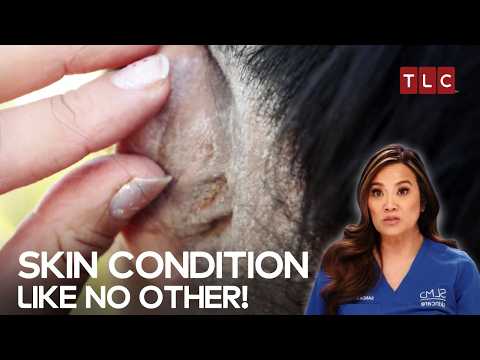 When A Patient has Elephant Skin! | Dr Pimple Popper TLC