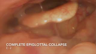 DISE - epiglottal collapse