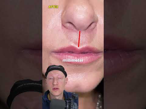 STUNNING Lip Lift Transformation