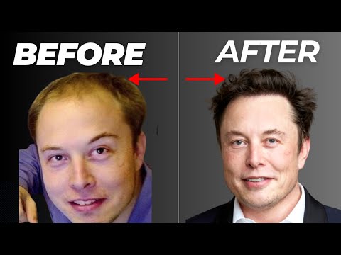 How Elon Musk Got His Hair Back: Doctors Reacts