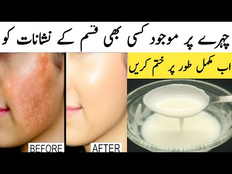 Cahre Ke Dagh Dhabe Door Karne Ka Tarika | How To Remove Face Pigmentation at Home