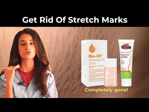 Treat stretch marks like a plastic surgeon - Dr. Hirra Alavi