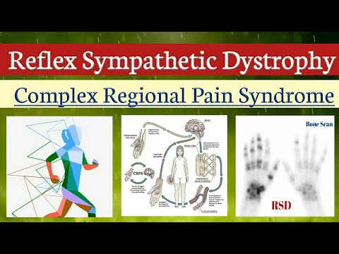 Reflex Sympathetic Dystrophy Syndrome (RDS) | Complex Regional Pain Syndrome