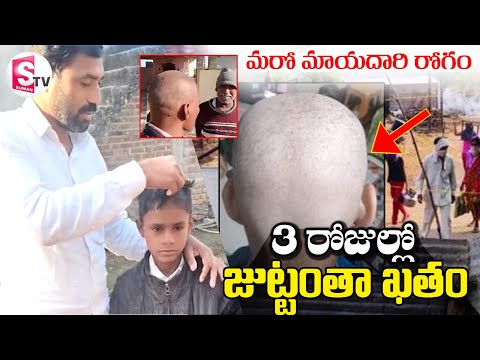 Mysterious Virus: మరో మాయదారి రోగం.. 3 రోజుల్లో జుట్టంతా ఖతం | Maharashtra | @SumanTVDwarakaTirumala