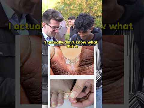 What’s this INFECTION BETWEEN the TOES? Doctor asks the public #shorts #doctor