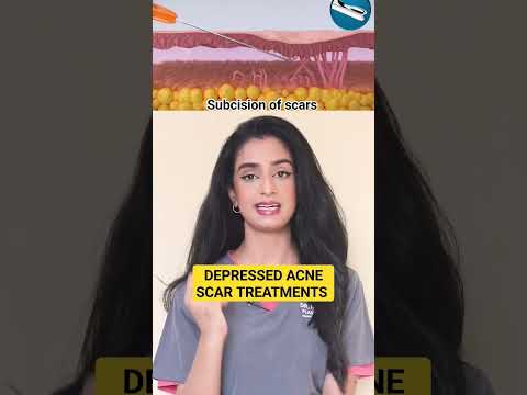 Treat depressed acne scars #acnescarremoval #acnescar #short