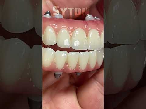 Here is another great SYTON, full-mouth restoration