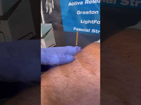 #dryneedling