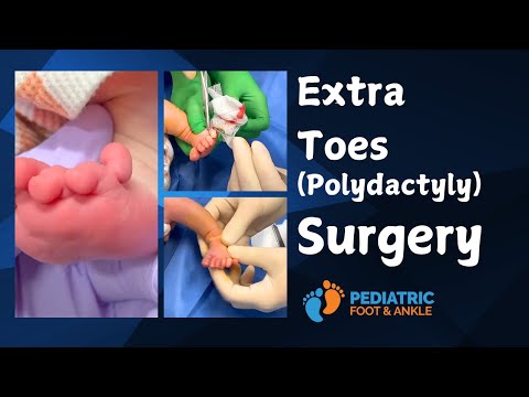 Correcting Foot Polydactyly (Extra Toes) in Infants and Babies (Graphic Content)