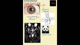 #Shorts|ClinicalCorrelation| NEET/NEXTPG/FMGE/MBBS| KF Rings | Wing Beating Tremors | Panda Sign