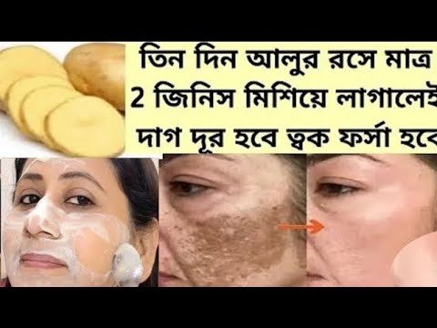 ত্বক হবে দাগহীন ফর্সা উজ্জ্বল গ্লোউইং রাতে লাগিয়ে নাও ঘরে তৈরী আলুর ক্রিম/Potato Facepack/Potato cre