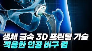 [핫클립] 생체 금속 3D 프린팅 기술을 적용한 인공 비구 컵 / YTN 사이언스