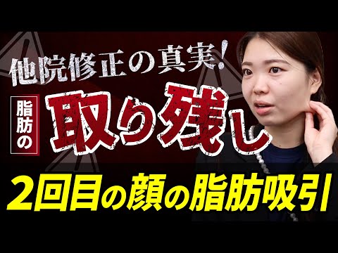 【再手術に密着】スタッフさんの2回目の脂肪吸引を担当。他院の脂肪の取り残しを再手術【顔の脂肪吸引】