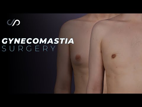 Gynecomastia | Male Breast Reduction with Dr. David Stoker