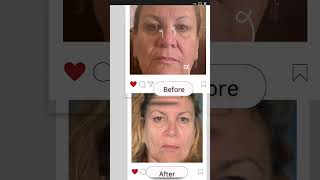 NIRA Pro Laser  One Month Results #nira_skin, #niratribe, #niralaser, #nira