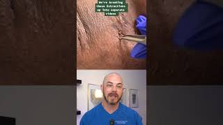 Derm reacts to SUPER SATISFYING extractions! #dermreacts #doctorreacts #pimplepop #cyst