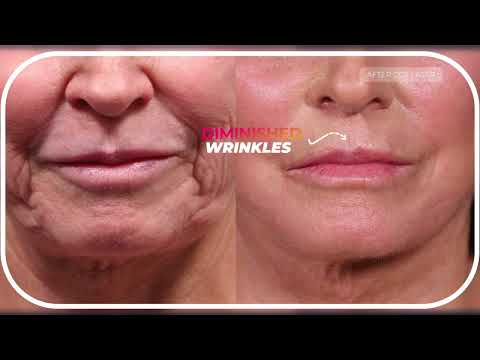 Facelift Results in 3 Months Are MIND-BLOWING!