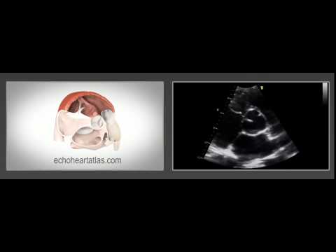 3D + Echocardiogram Sample - Echocardiography Heart Atlas