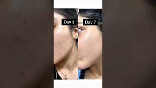 Best pimple remedies at home high resquetd  video#pimplefreeface#homeremedies #clearskin #shorts