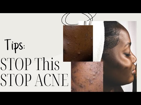 HERE IS WHY YOUR ACNE HAS REFUSED TO LEAVE.