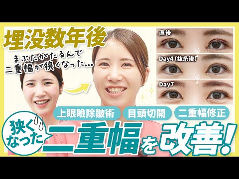 【二重幅が狭くなってしまった方へ】「8年前の埋没二重が…」瞼のたるみ取り＋二重幅修正で理想の二重幅を取り戻す！実際のダウンタイム経過と仕上がりをリアルに公開！