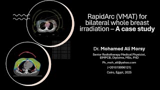 RapidArc (VMAT) for Bilateral Whole Breast Radiotherapy