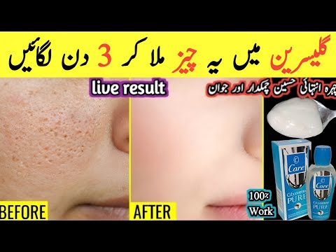 Best Remedy Clear & Glowing Skin | Sun Tan Removal Home Remedy | Glycerine Remedy