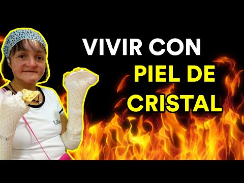 VIVIR CON PIEL DE CRISTAL (Entrevista a Soni)