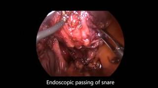 Incidental Finding of Ligated Left Gastric Pedicle During Revision of VBG to Bypass