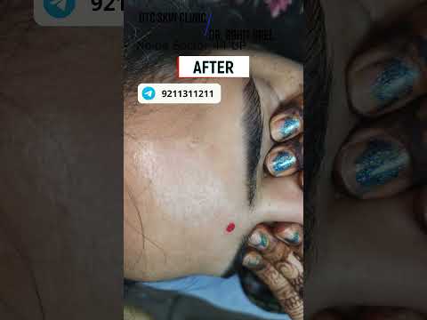 Dr. Rohit Goel | wart removal