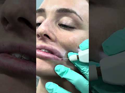 WOW! Plasma Pen Lesion Removal Near Lips:  Quick Demo