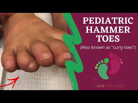 Hammertoes & Curly Toes in Children