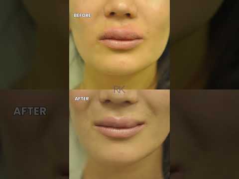 Lip Filler Correction with Juvederm! 💉 #juvederm #lipfiller #filler #derformed #beauty