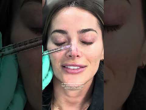 Nose Filler Gone Wrong? Watch the Dissolving Process Part 2 #nosefiller