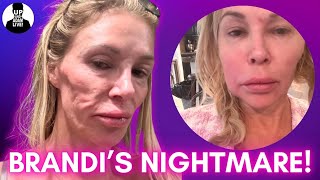 Brandi Glanville's Disturbing  "Miserable Melted Away" Faced Update! #bravotv